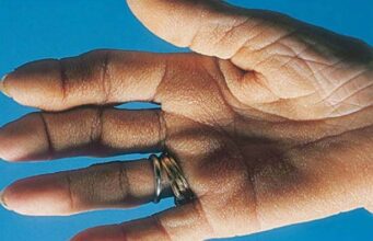 Two Conditions That Are Often Misdiagnosed as Carpal Tunnel Syndrome: Understanding the Differences