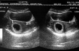Things That Can Cause a Miscarriage in the First 8 Weeks: Understanding Early Pregnancy Risks
